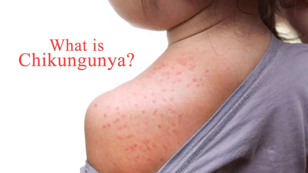 Chikungunya Rashes Chikungunya Rashes